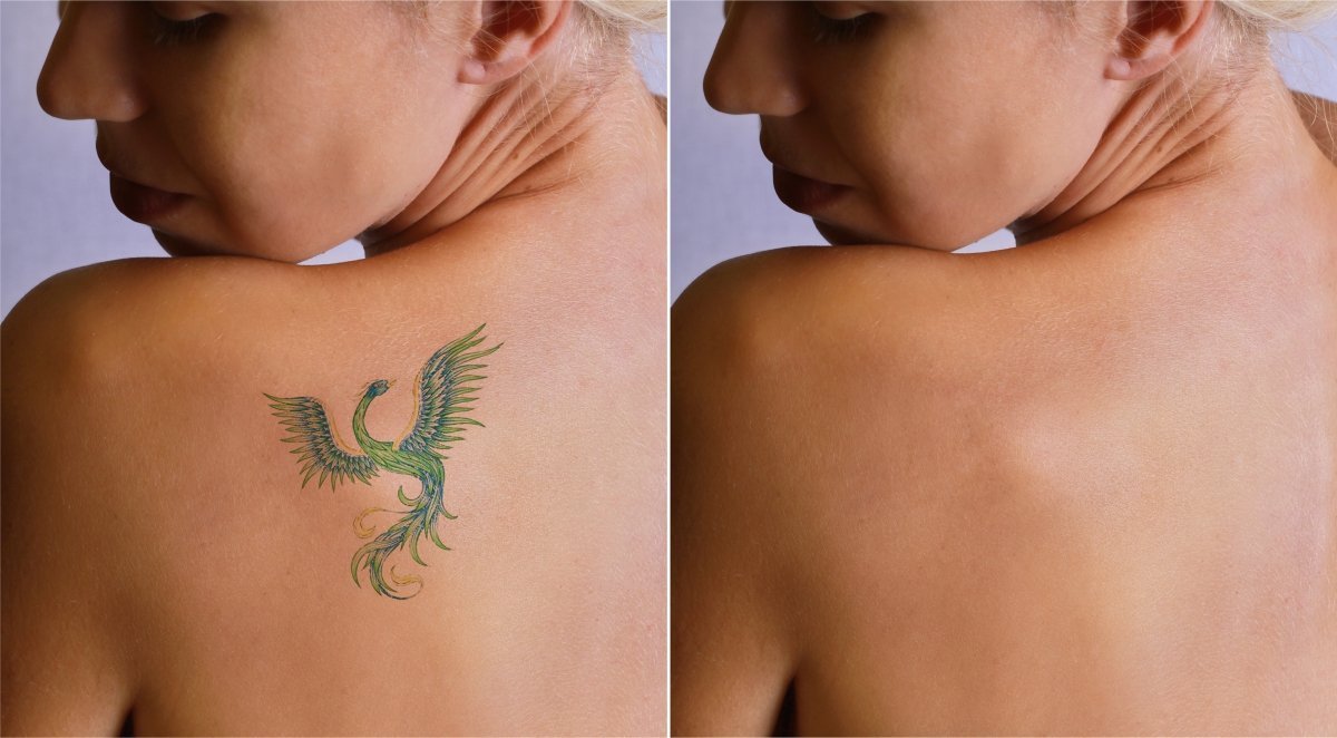 Laser Tattoo Removal Treatments